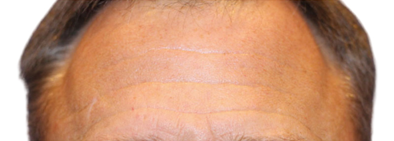 Botox Before and After | PERK Plastic Surgery