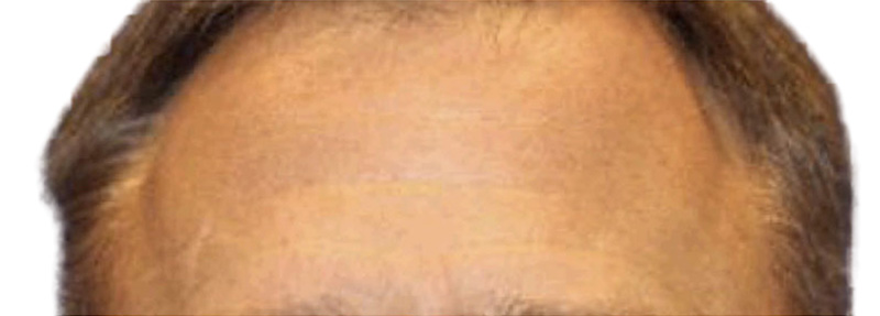 Botox Before and After | PERK Plastic Surgery