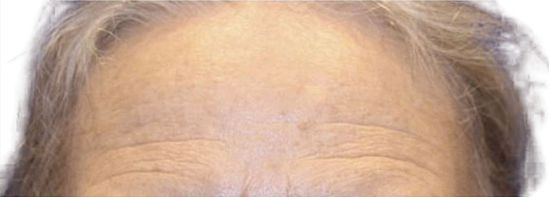 Botox Before and After | PERK Plastic Surgery