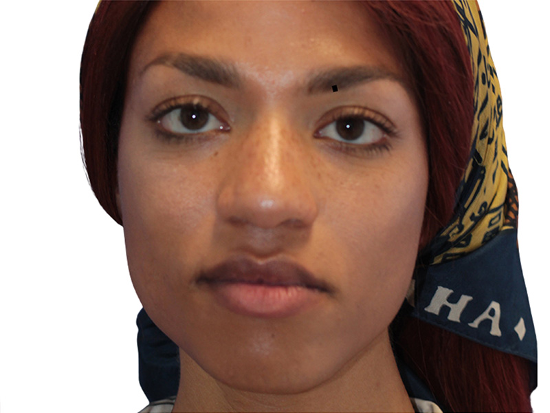 Botox Before and After | PERK Plastic Surgery