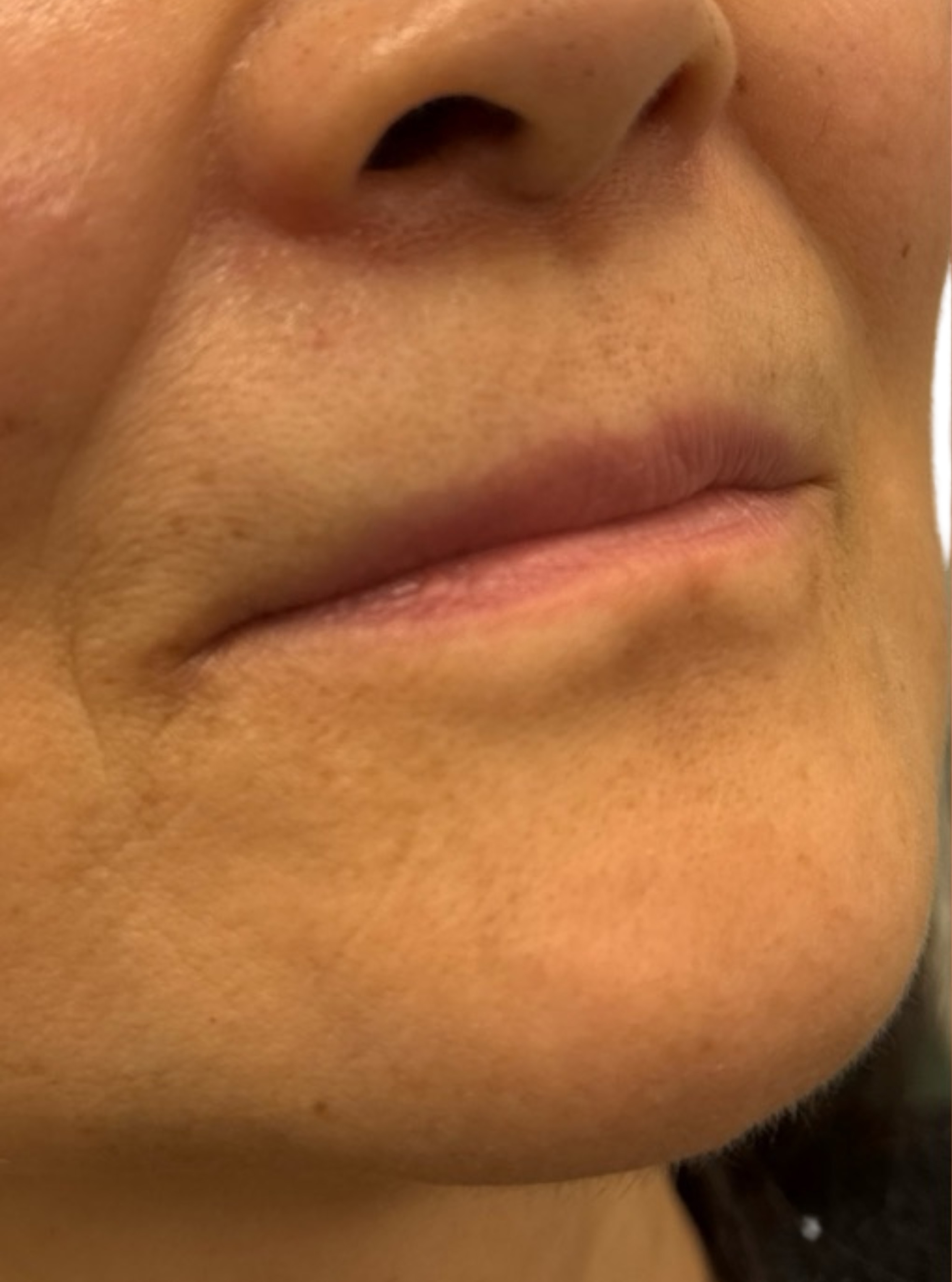 Filler Before and After | PERK Plastic Surgery