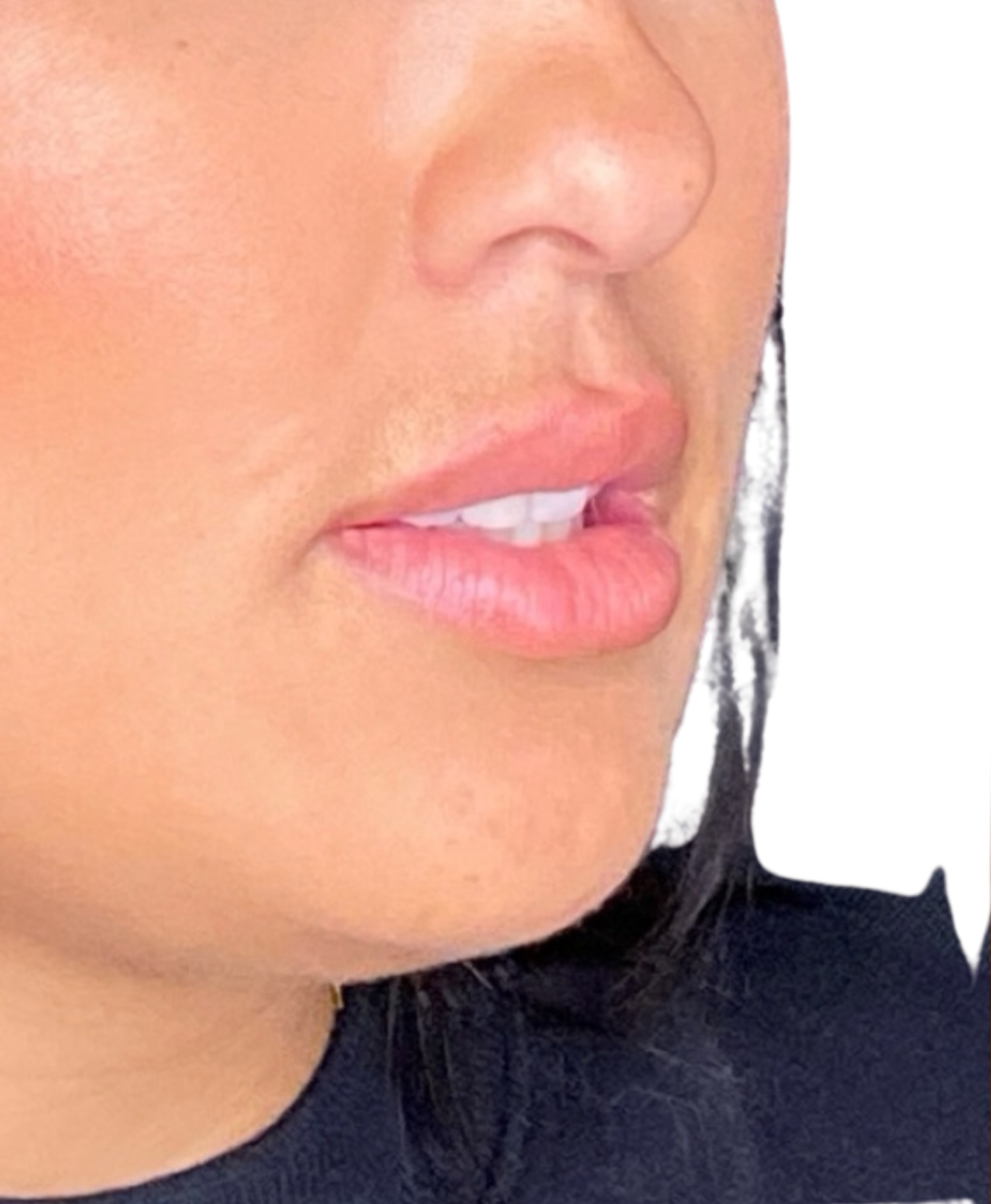 Filler Before and After | PERK Plastic Surgery
