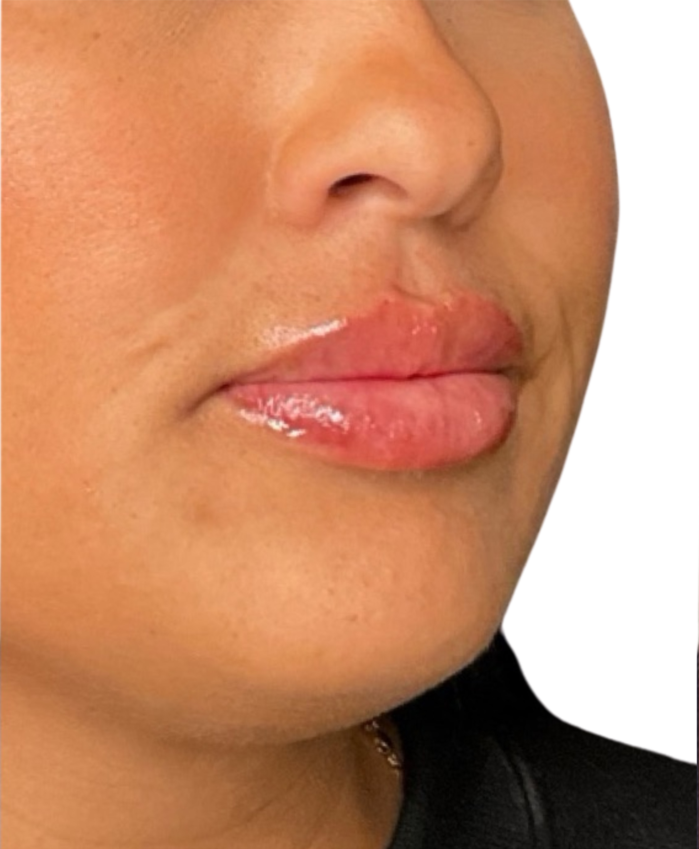 Filler Before and After | PERK Plastic Surgery