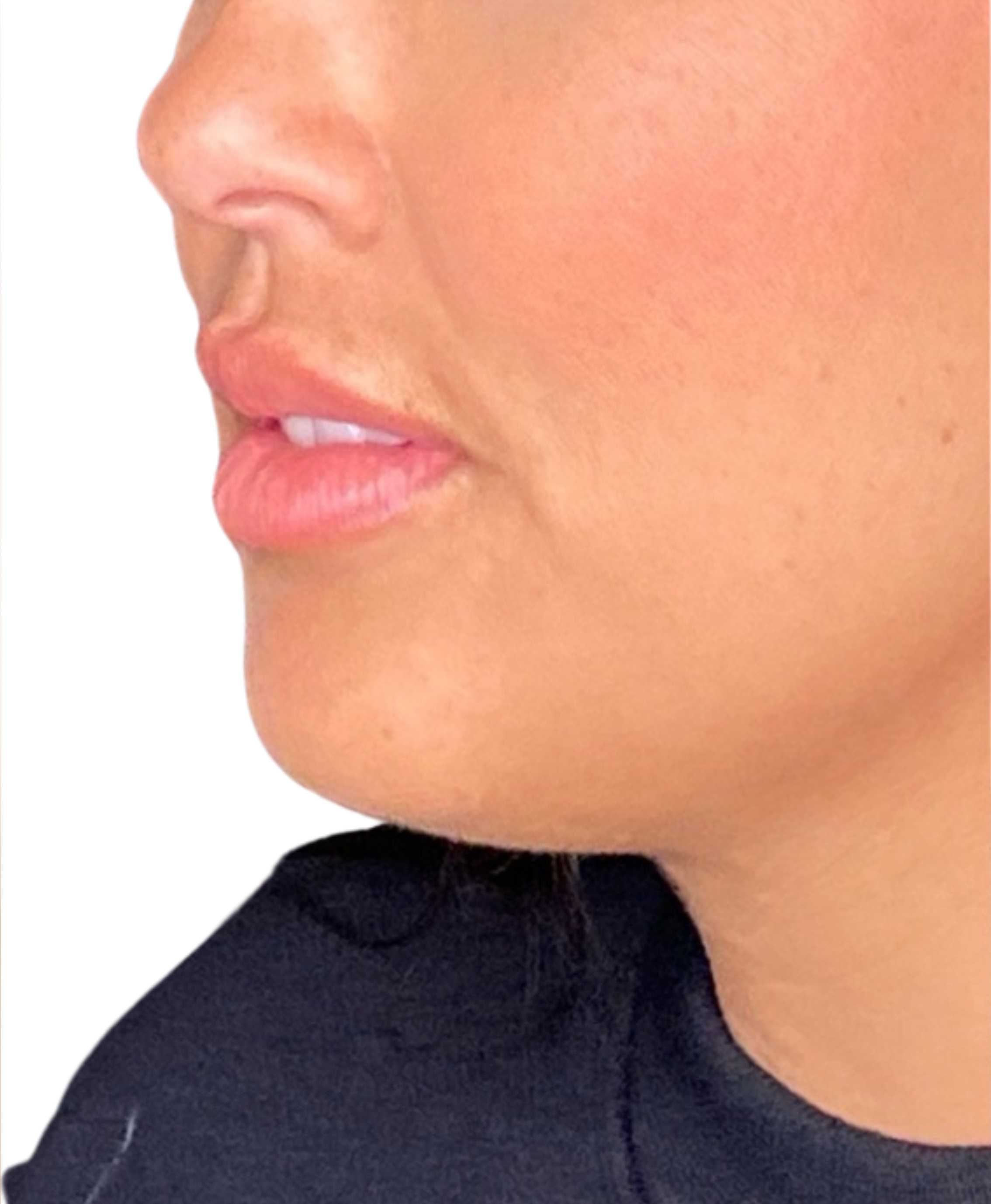 Filler Before and After | PERK Plastic Surgery