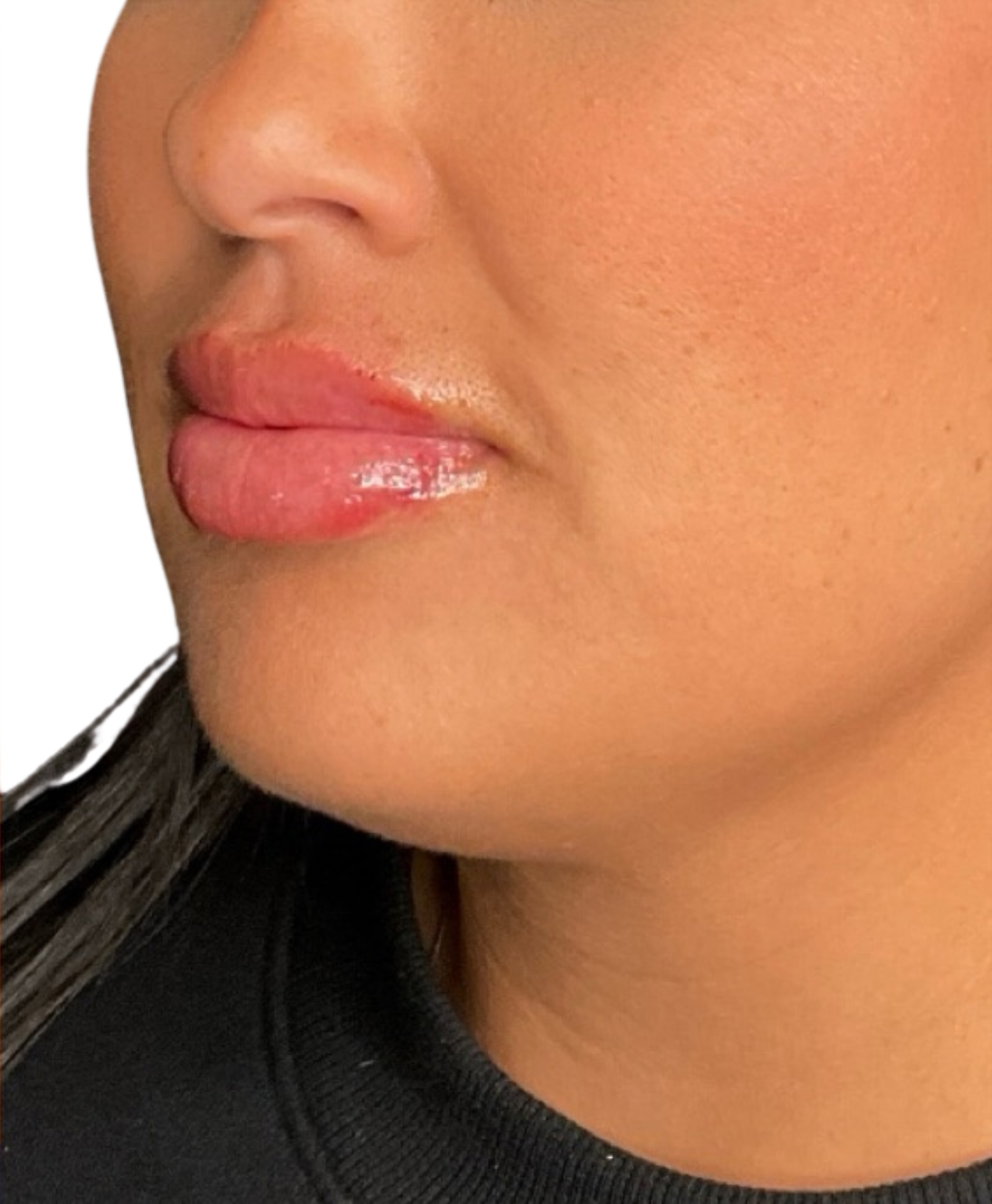 Filler Before and After | PERK Plastic Surgery