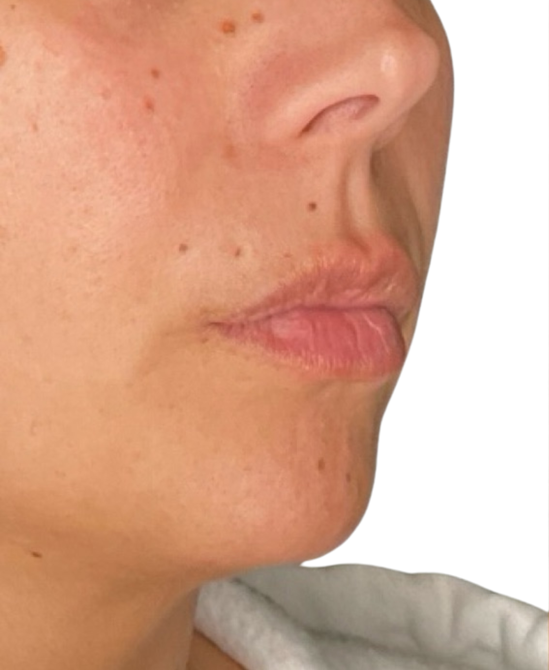 Filler Before and After | PERK Plastic Surgery