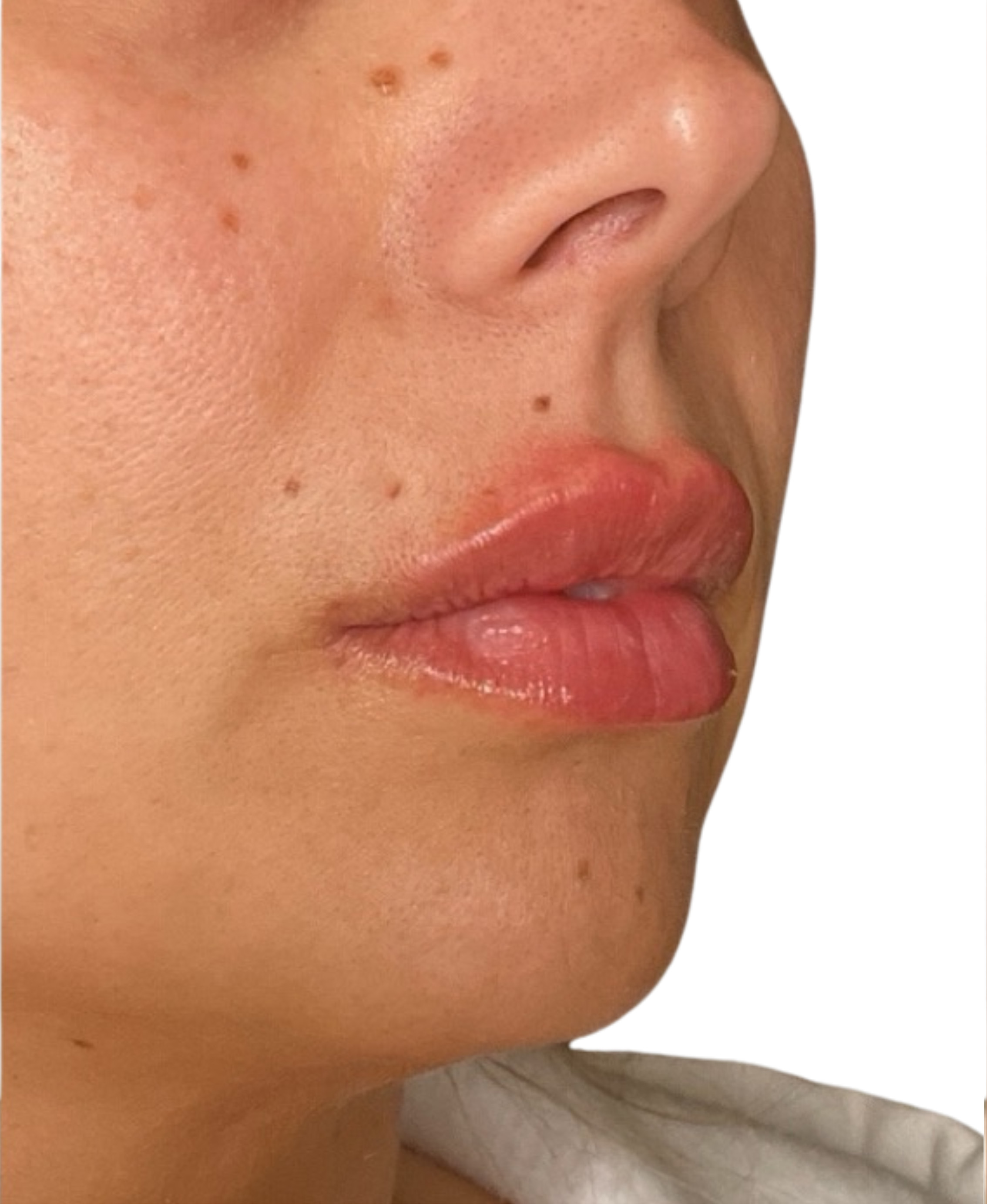 Filler Before and After | PERK Plastic Surgery