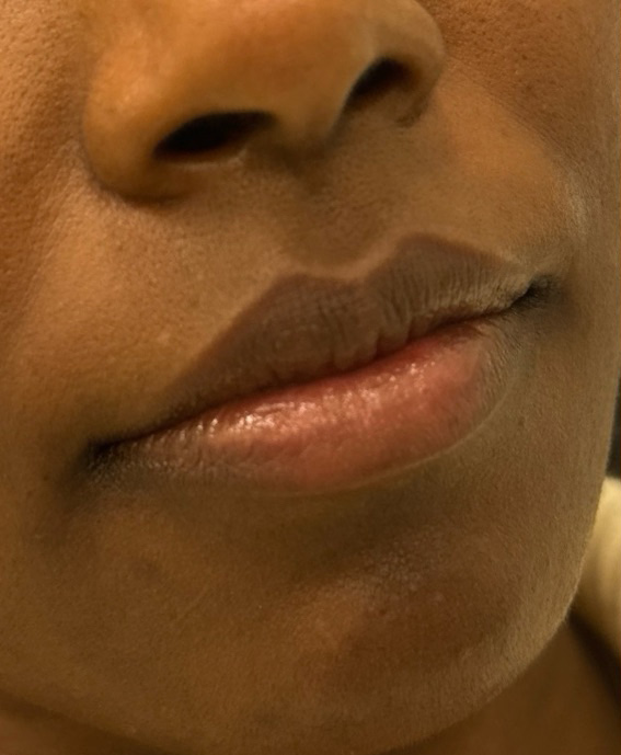Filler Before and After | PERK Plastic Surgery