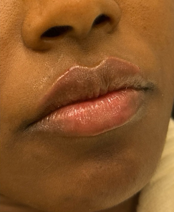 Filler Before and After | PERK Plastic Surgery