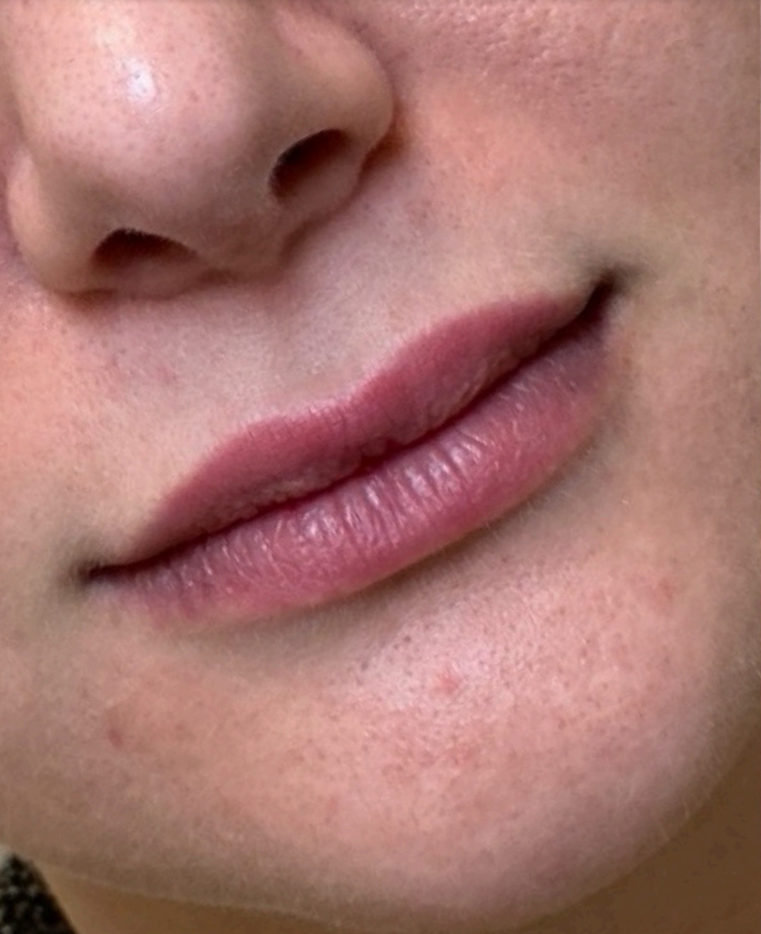 Filler Before and After | PERK Plastic Surgery
