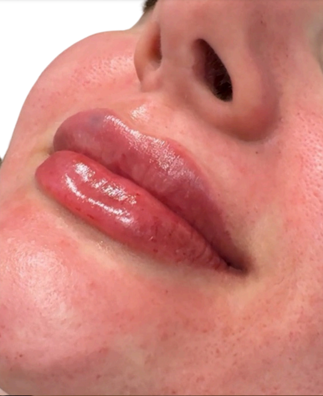 Filler Before and After | PERK Plastic Surgery