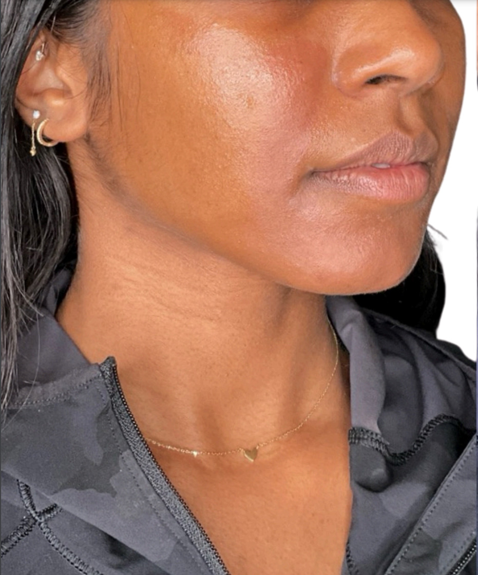 Filler Before and After | PERK Plastic Surgery