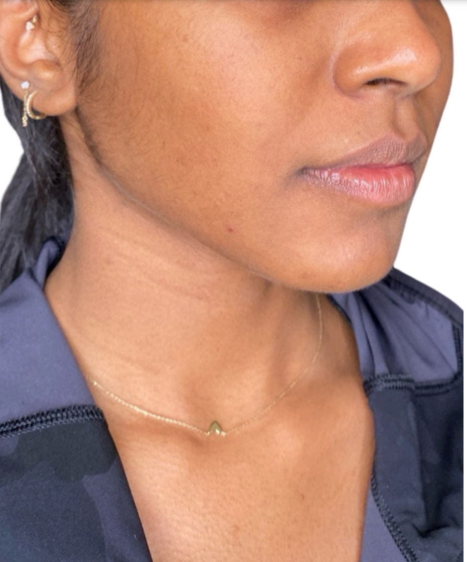 Filler Before and After | PERK Plastic Surgery