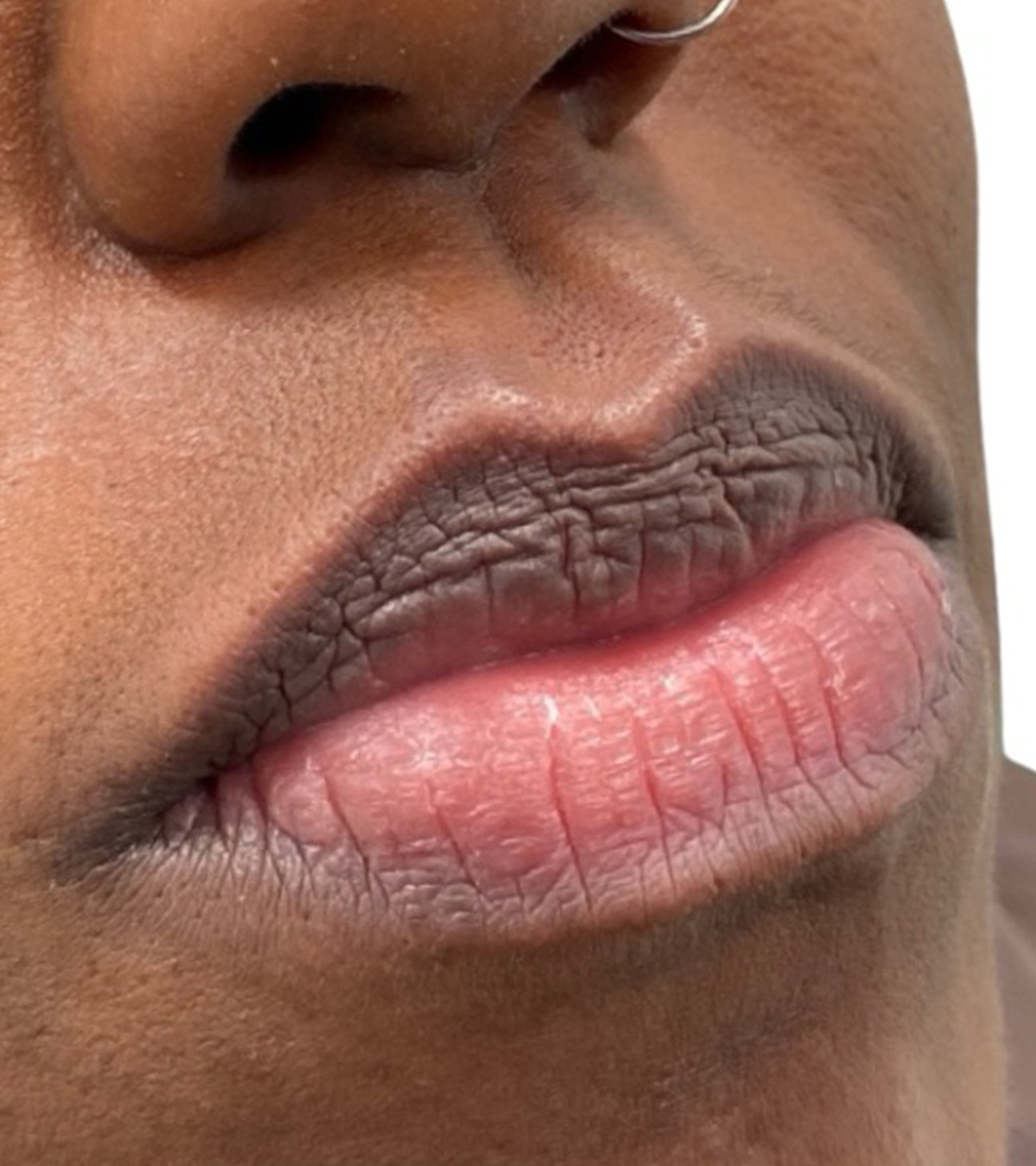 Filler Before and After | PERK Plastic Surgery