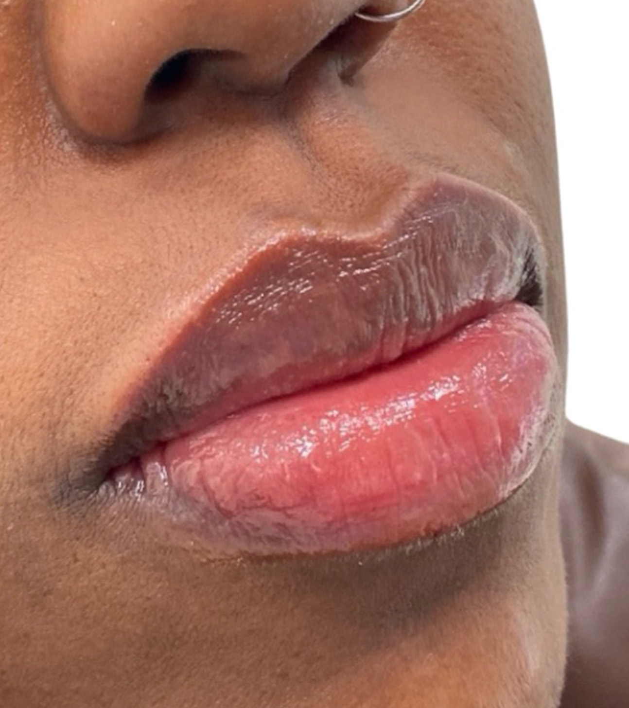 Filler Before and After | PERK Plastic Surgery