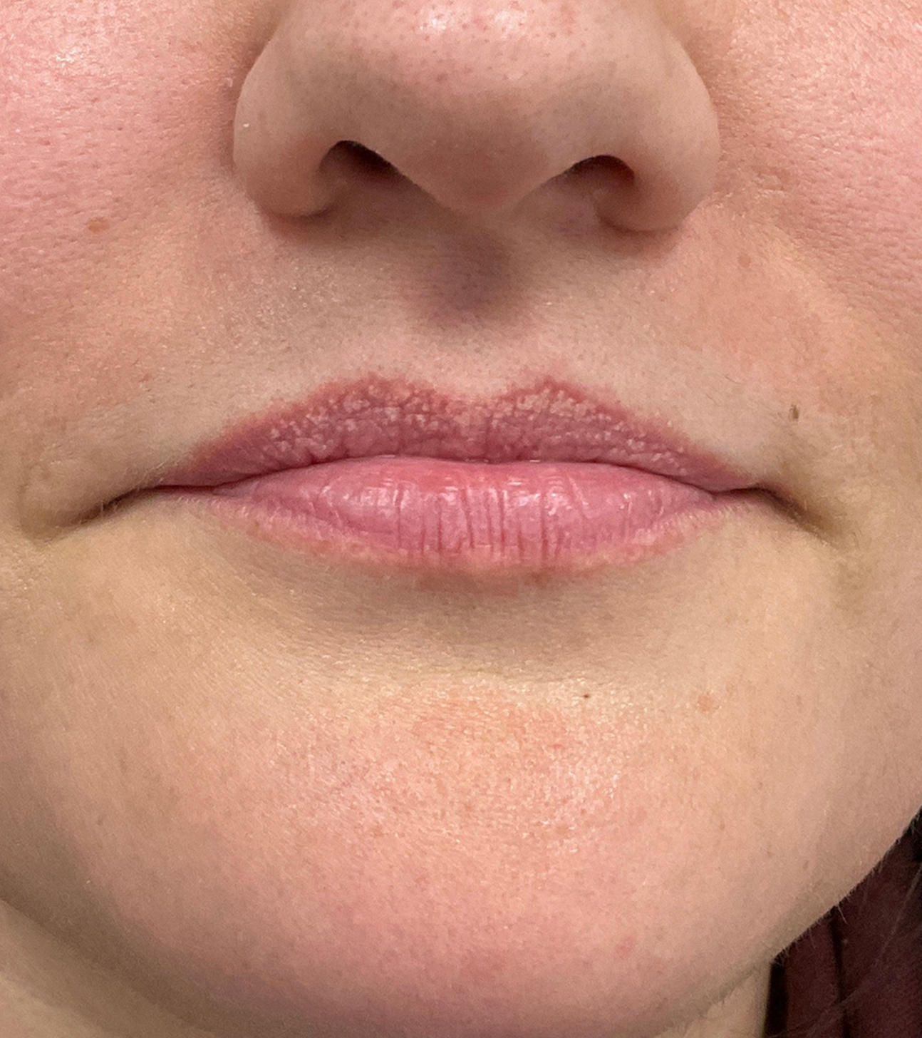 Filler Before and After | PERK Plastic Surgery