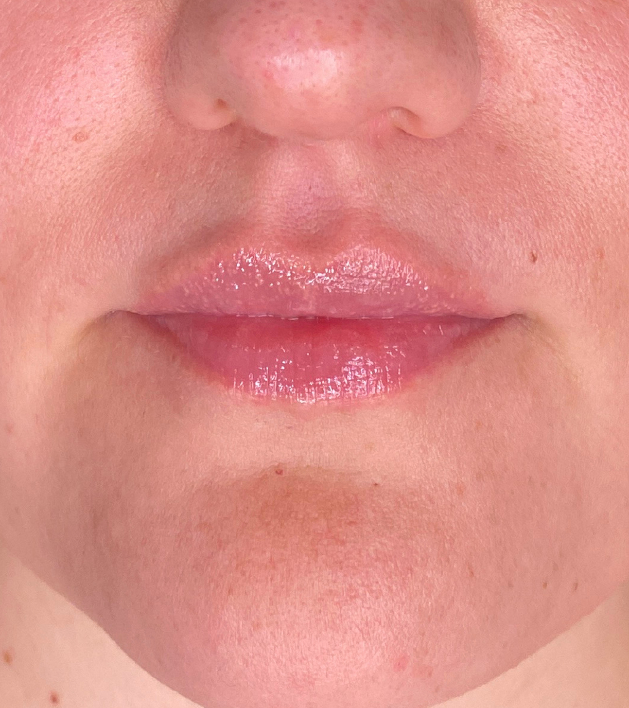 Filler Before and After | PERK Plastic Surgery