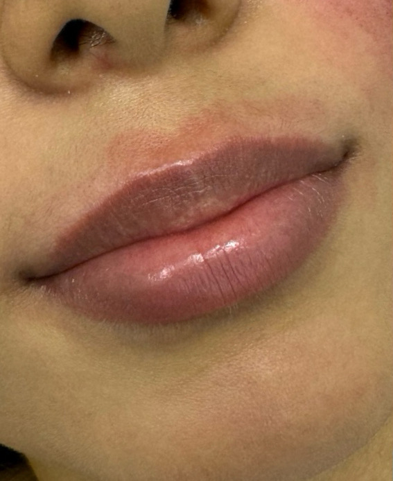 Filler Before and After | PERK Plastic Surgery