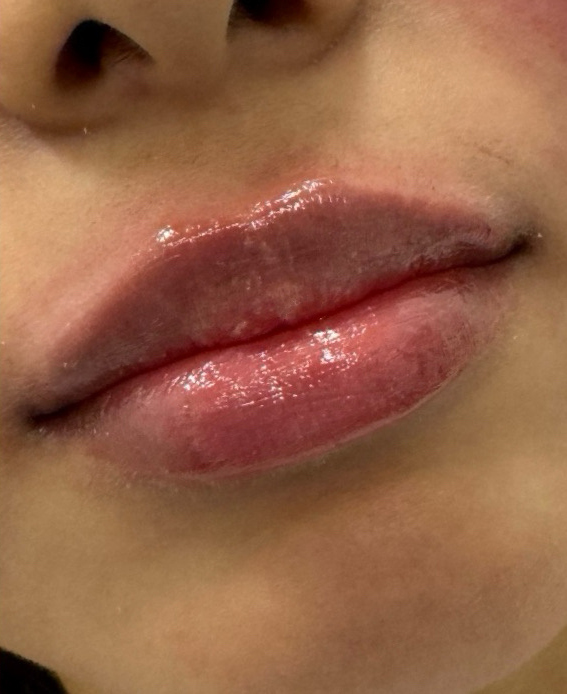 Filler Before and After | PERK Plastic Surgery