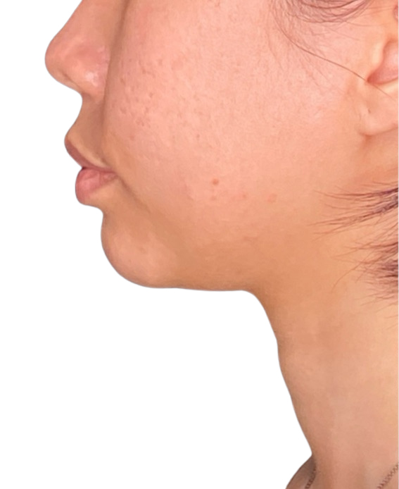 Filler Before and After | PERK Plastic Surgery