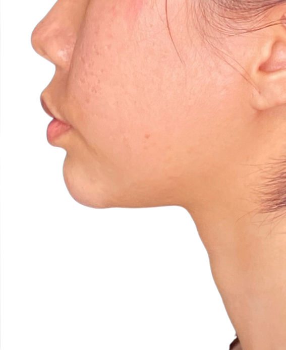 Filler Before and After | PERK Plastic Surgery