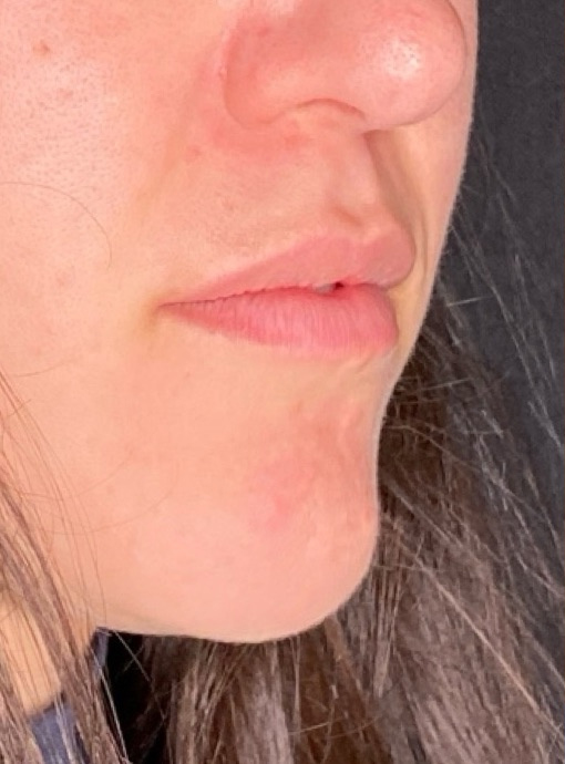 Filler Before and After | PERK Plastic Surgery