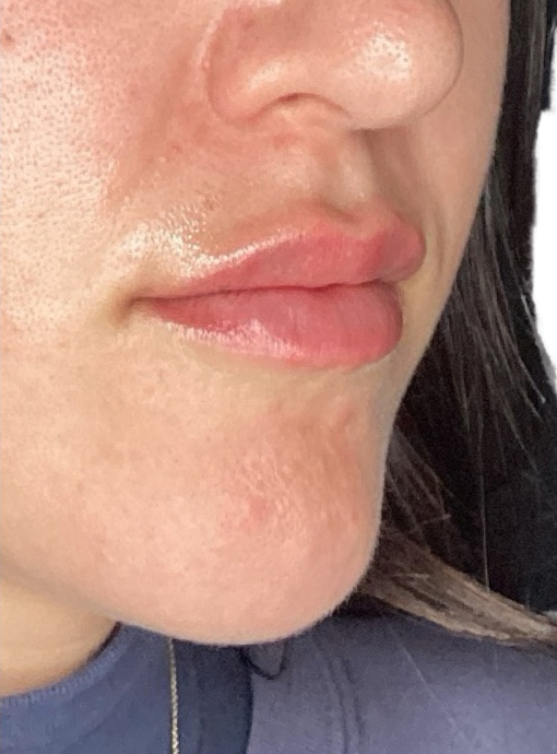 Filler Before and After | PERK Plastic Surgery