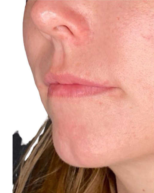 Filler Before and After | PERK Plastic Surgery