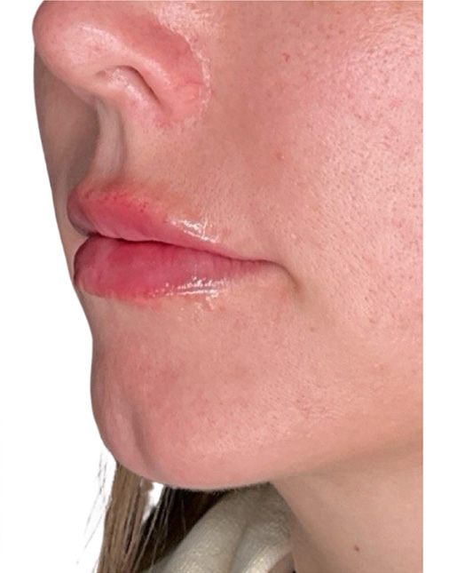 Filler Before and After | PERK Plastic Surgery