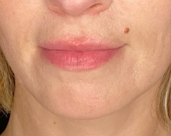 Filler Before and After | PERK Plastic Surgery