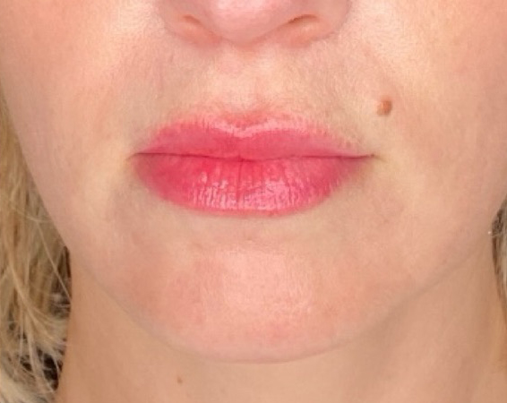 Filler Before and After | PERK Plastic Surgery