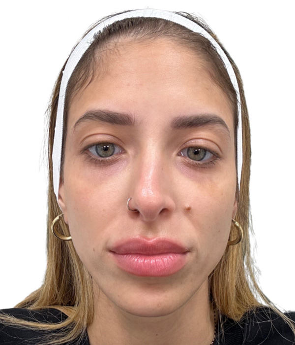 Filler Before and After | PERK Plastic Surgery