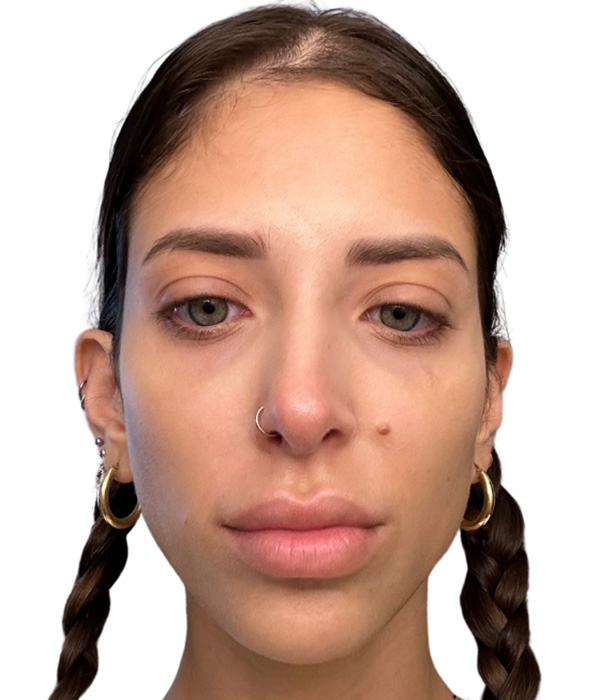 Filler Before and After | PERK Plastic Surgery