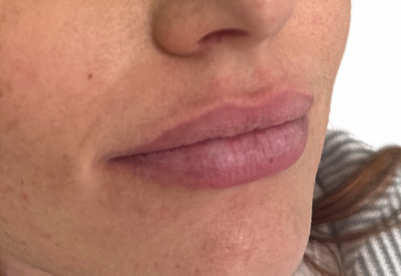 Filler Before and After | PERK Plastic Surgery