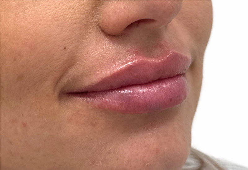 Filler Before and After | PERK Plastic Surgery