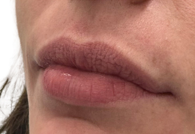 Filler Before and After | PERK Plastic Surgery