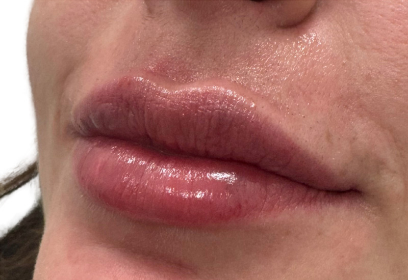 Filler Before and After | PERK Plastic Surgery