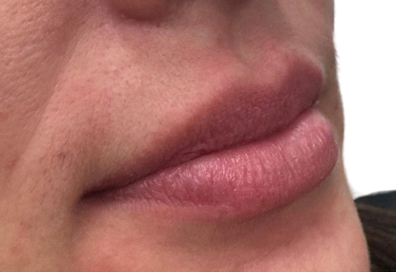 Liquid Rhinoplasty Beverly Hills