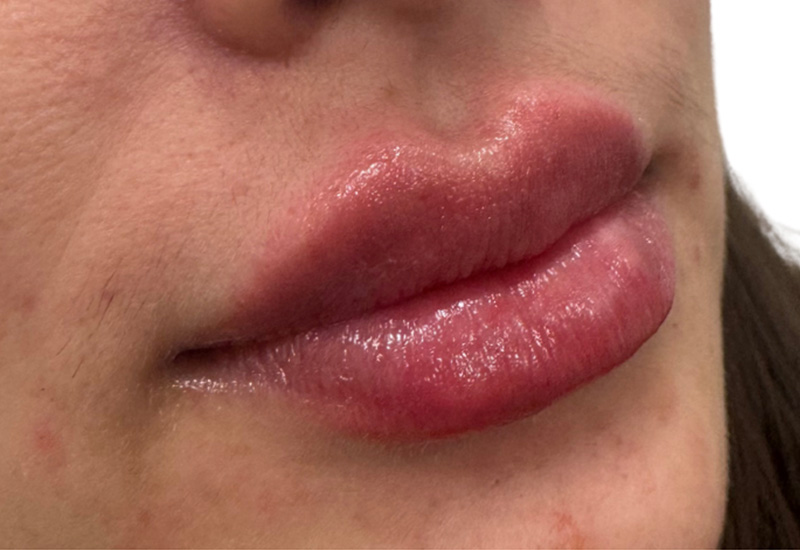 Liquid Rhinoplasty Beverly Hills