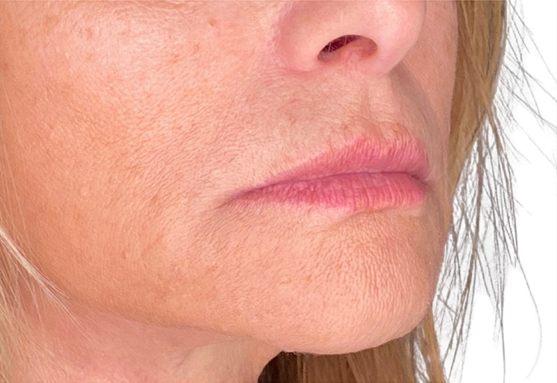 Filler Before and After | PERK Plastic Surgery