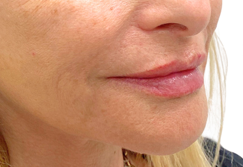 Filler Before and After | PERK Plastic Surgery