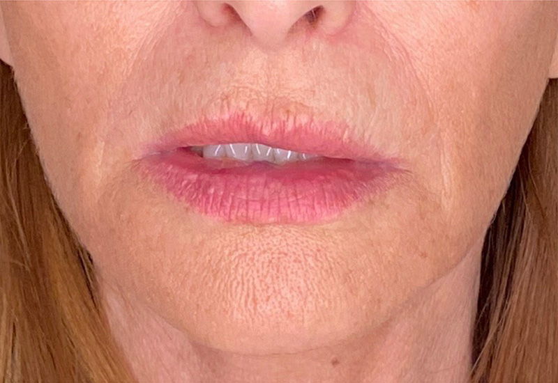Filler Before and After | PERK Plastic Surgery