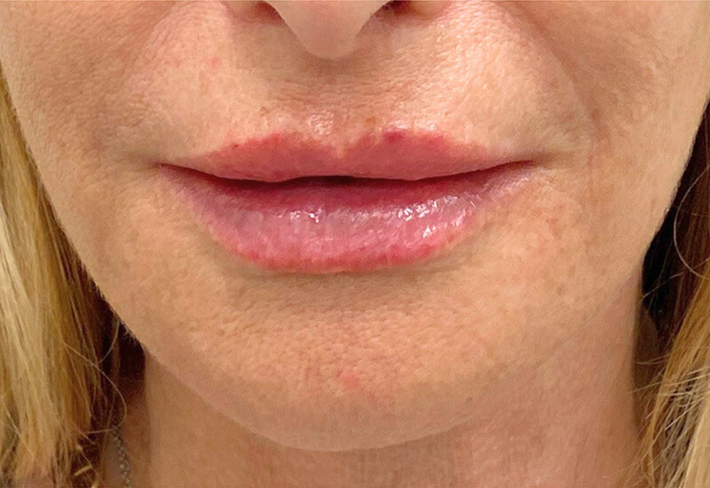 Filler Before and After | PERK Plastic Surgery