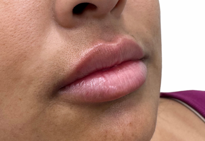 Filler Before and After | PERK Plastic Surgery