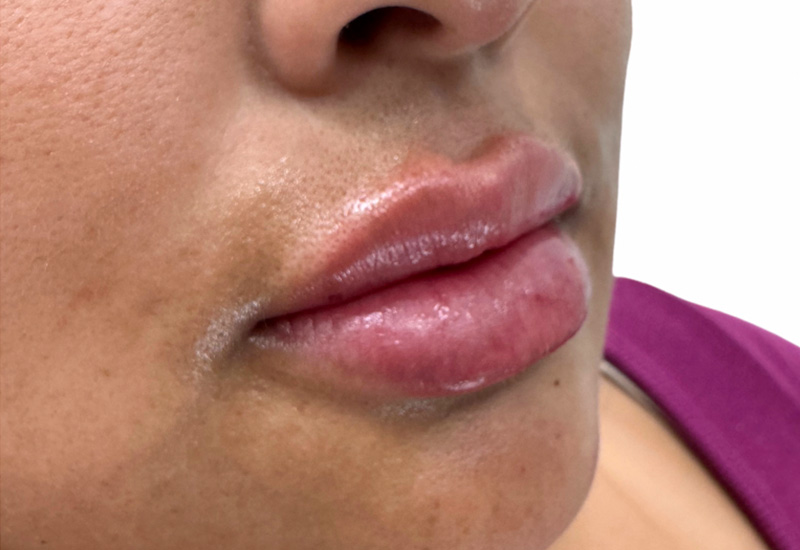 Filler Before and After | PERK Plastic Surgery