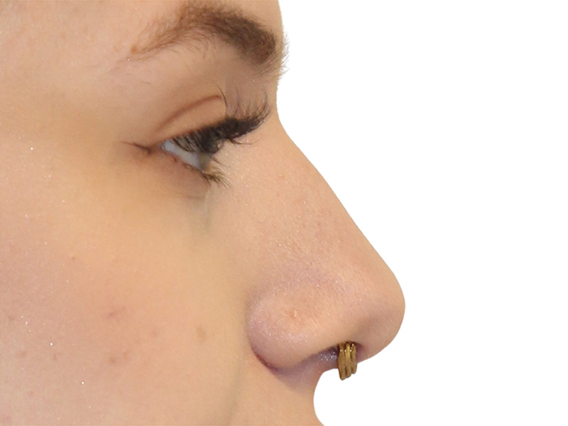 Filler Before and After | PERK Plastic Surgery