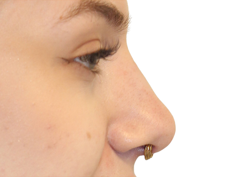 Filler Before and After | PERK Plastic Surgery