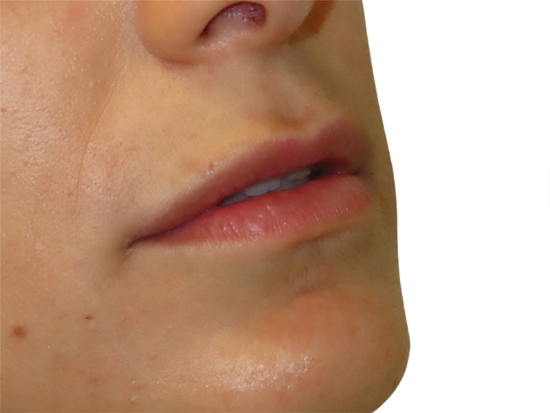 Filler Before and After | PERK Plastic Surgery