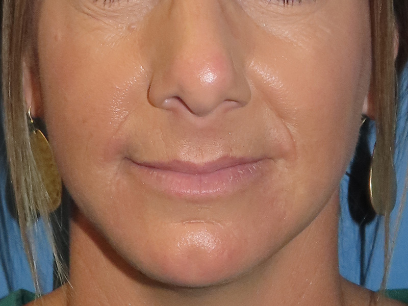 Filler Before and After | PERK Plastic Surgery