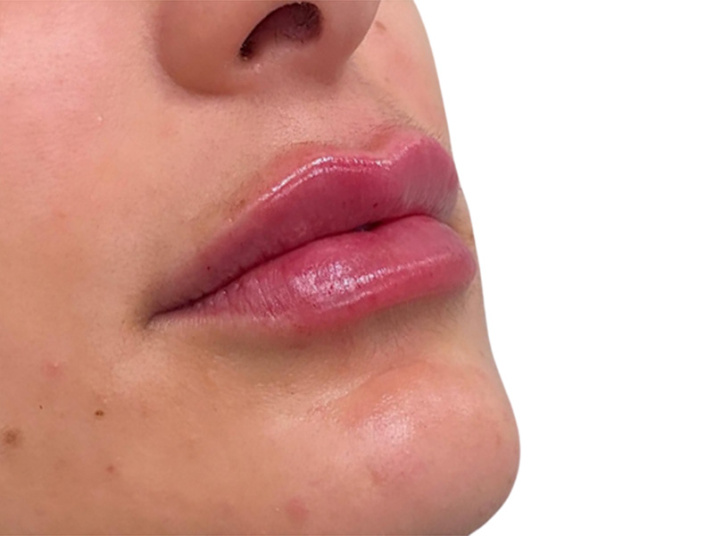 Filler Before and After | PERK Plastic Surgery